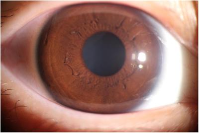 Implementation and Application of an Intelligent Pterygium Diagnosis System Based on Deep Learning